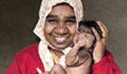 Hindistan'da Bir Bebek Kurt Adam Sendromu İle Dünyaya Geldi
