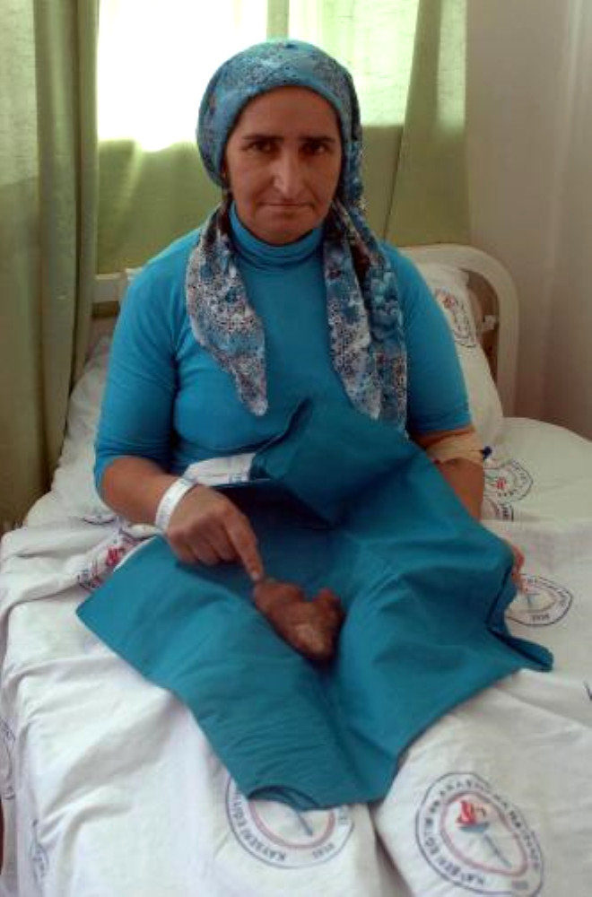 On yldr bbreindeki tatan habersiz yaayan Aysel Yiit (45) karn arsnn iddeti artnca Kayseri Eitim ve Aratrma Hastanesi