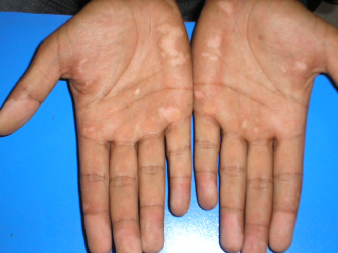 KMLERDE GRLR? :
Her yata grlebilen vitiligoya her yz kiinin 12 sinde rastlanr. Hastalarn yarsnda 20 yandan nce balar.
