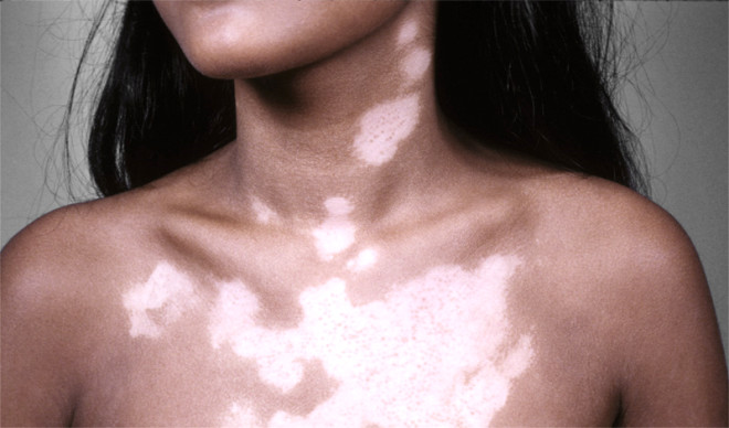 VTLGONUN NEDEN NEDR? : 
Vitiligoda deri rengini meydana getiren hcrelerin kayb ve derinin beyazlamas sz konusudur. Birok faktr zerinde durulmakla birlikte hastaln nedeni halen tam bilinmemektedir. Hastalarn yzde 30