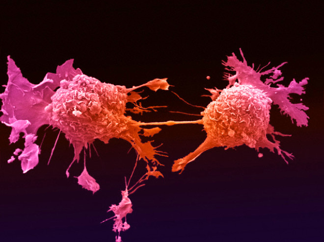 Kk hcreli akcier kanseri, daha hzl byyen ve vcudun dier yerlerine daha fazla yaylan trdr ve tm akcier kanserlerinin %20