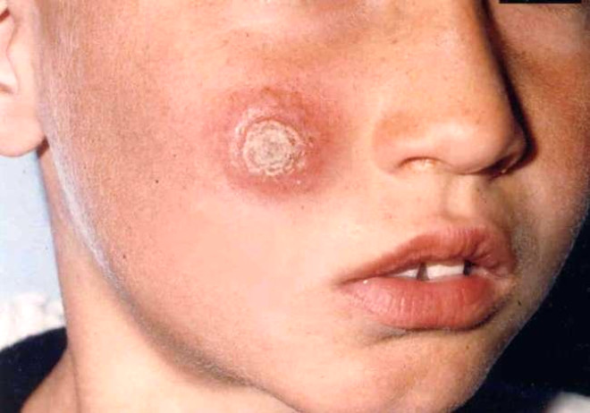 Yakaan olarak bilinen tatarck sinei lmcl hastalklara neden olabiliyor.