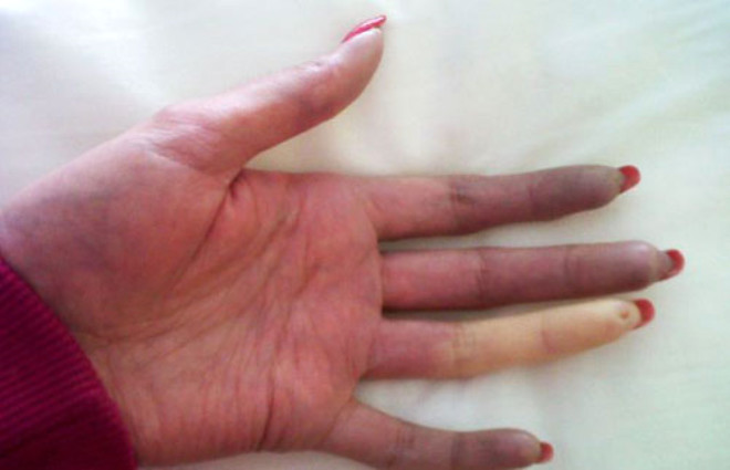 Kk bir soukta parmaklarda klcal damarlar ekiliyor ve parmak beyazlamaya balyor. 