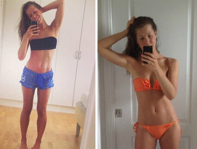 18 yandaki Antonia Eriksson anoreksiya rahatszl sebebiyle organlar iflas etmek zereyken hastaneye yatrld.
