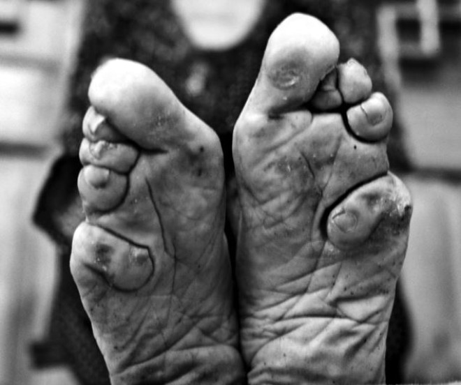 Bal ayaklar ile yaayan son inli kadnn 100 yl sonra gzellik ve stat sembol olarak grdkleri asrlk gelenekleri yasakland.
