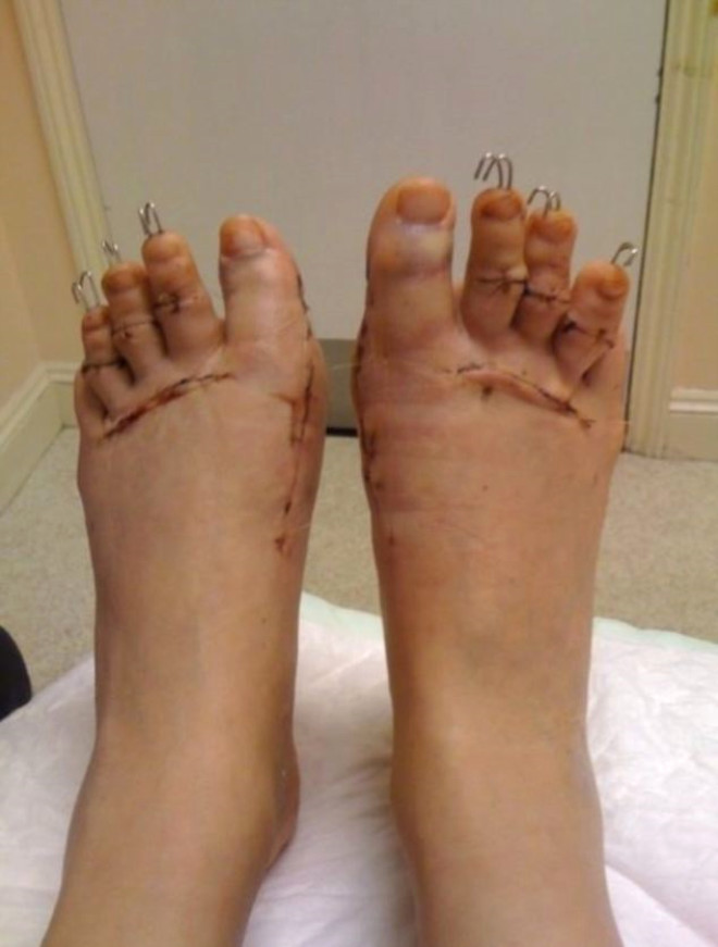 Sindirella ameliyat sonras topuklu ayakkab giymek bir yana, ayak parmaklarn hareket dahi ettiremeyen Sandler, ayaklarnn operasyon ncesinden daha fazla ac verdiini belirtiyor.
