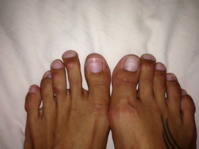 Sindirella ameliyat ad verilen ayak estetik ameliyatlarnda, genellikle ba parmaktan daha uzun olan ikinci ve nc parmaklar kesilerek ksaltlyor.
