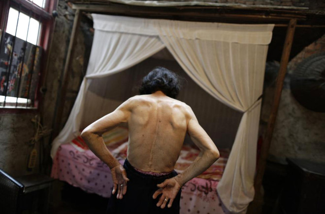 Kanser tedavisi gren 78 yandaki Qin Zhengyu, Reuters foto muhabiri Jason Lee