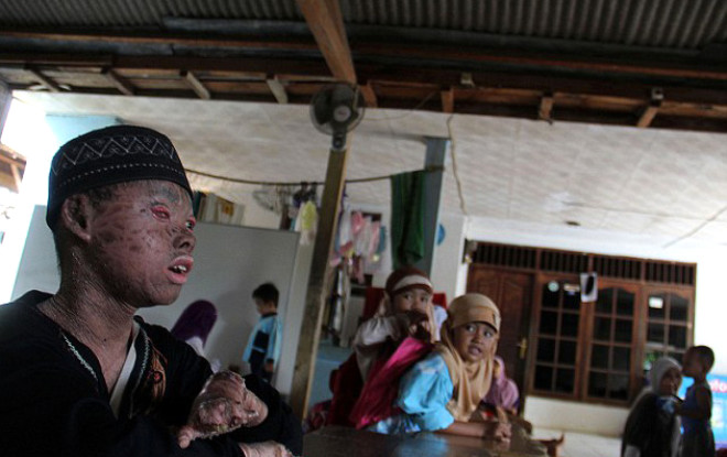 Endonezyada yaayan 16 yandaki Ari Wibowo, krmz adam sendromu olarak bilinen bir hastala yakaland. Bu hastalkta pul pul dklen derinin her zaman slak tutulmas gerekiyor.
