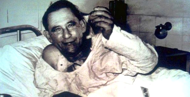 Tarihte ilk kalp nakli yaplan insan, Louis Washkansky. Fotoraf, 6 Aralk 1967 tarihinde, ameliyattan  gn sonra ekilmi.

