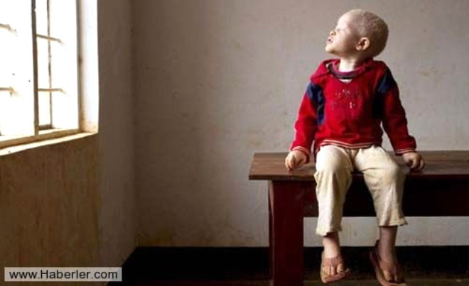 
Bir albinonun kafa derisi, elleri ve ayaklar 250 bin dolara kadar kan paralara satlyor.



 

