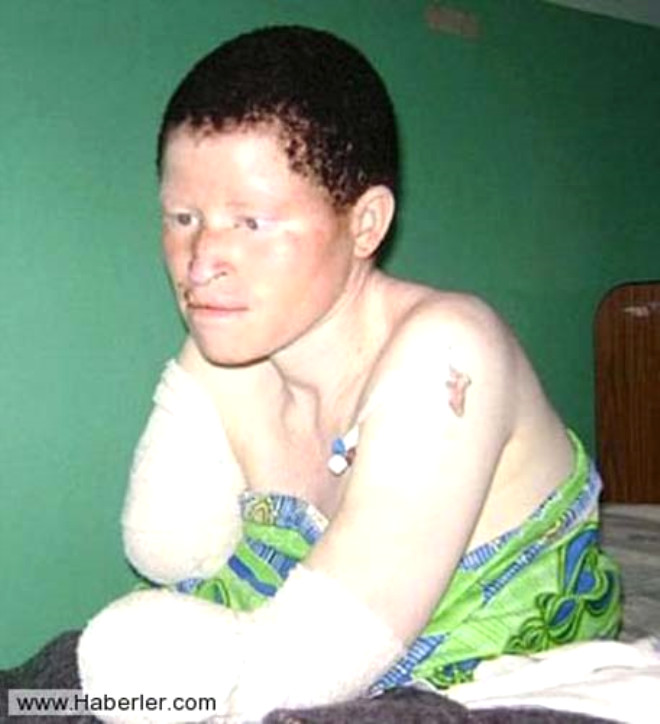 Blgede, "albinolarn organlarnn eitli hastalklara iyi geldiine inanan" yerel dinlere mensup bycler, albino cinayetlerini tevik ediyor.

