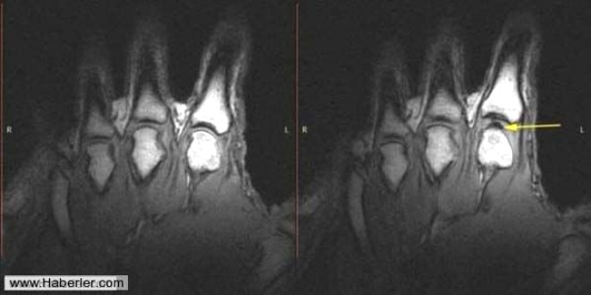 Sadaki MRI grnts parmak tlatma esnasnda eklem arasnda oluan boluu gsteriyor.

