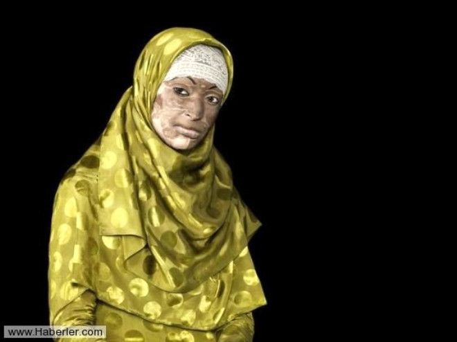 22 yandaki Umma Aysha, kocasnn yzne att asit sonras hayatta kalmay baard ve u an finans okuyor.
