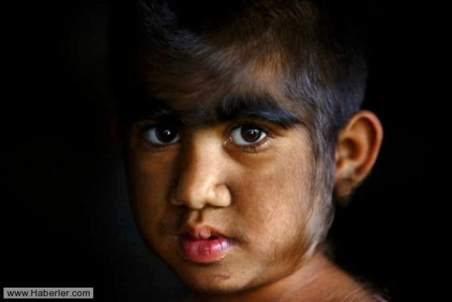 
Mandira "kurt adam sendromu" olarak bilinen doumsal Klllk hastalndan, muzdarip.7 yandaki Mandira, Budhathoki
