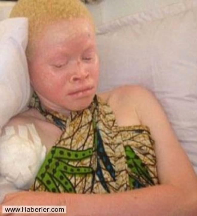 Organlarn zenginlik veren iksir yapmnda kullanmak iin ldrlen albino says, bir ylda 26