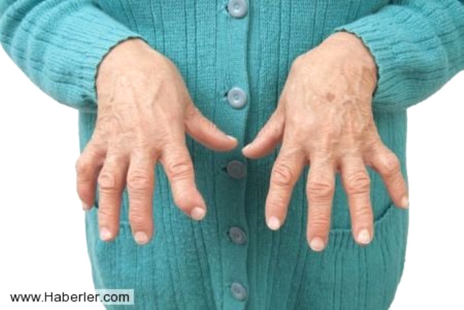 Romatoid artrit
