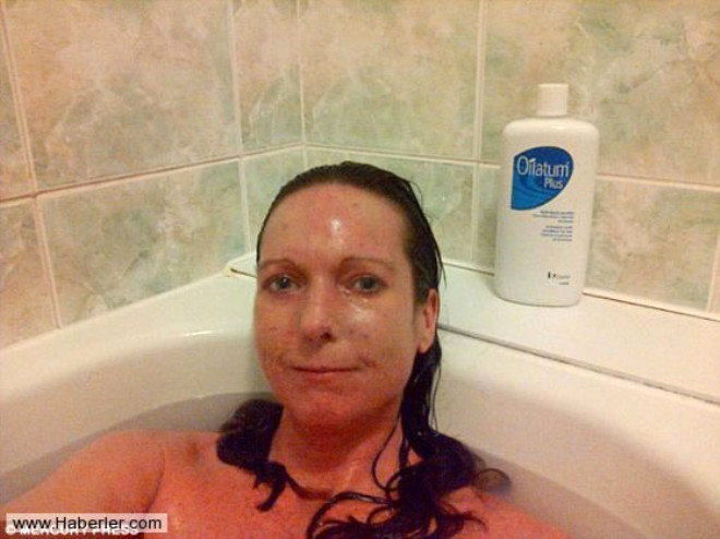 Nicola Whitehill isimli Skleroderma hastas kadn, derisi sk olmas nedeniyle edebilmek iin her gn 3 saat ya banyosu yapp vcudunu kremliyor.
