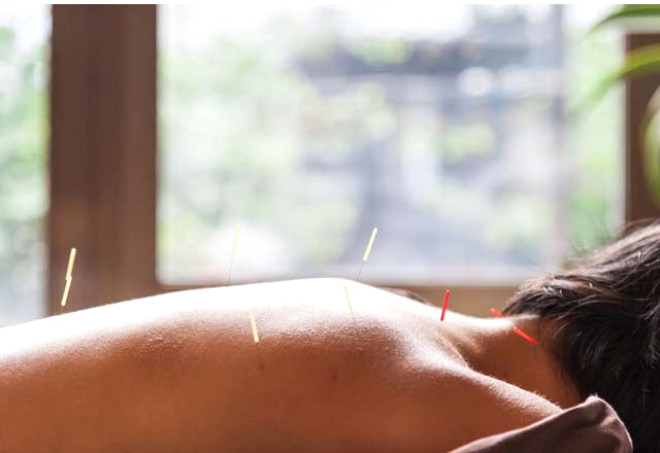 Akupunktur, ince ve kk inelerin vcudun belli yerlerine batrlarak yaplan bir terapidir. Ary azaltma, modu ykseltme gibi birok yarar vardr.

 

Baz anneler, daha kolay ve hzl hamile kalmasn akupunktura balyor. 
