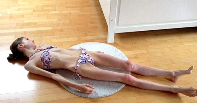 19 yandaki anoreksi (itahszlk) hastas Chiara Schober 22 kiloya derek lme derecesinde iken hayata tutundu.
 
