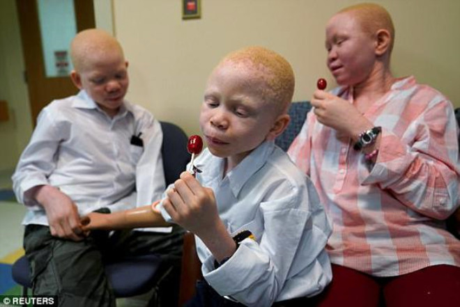 Her 2 bin ocuktan birinde grlen Albino hastalna yakalananlar, genetik bir bozukluk sebebiyle sahip olduklar beyaz sa ve ten renginden dolay vahice katlediliyor.
