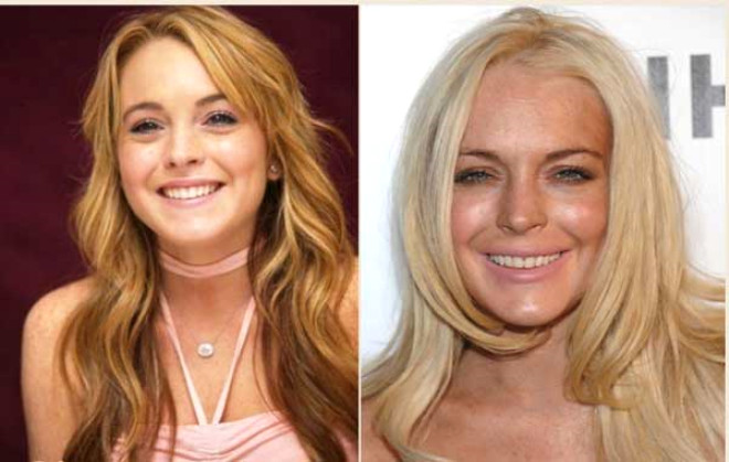31 yandaki Amerikal oyuncu, model ve arkc Lindsay Lohan baz ruhsal problemler yaad ve uzun sre rehabilitasyon grd. Tm bunlarn ardndan grnnde deiiklik yapmaya karar verdi ve zellikle yznn st ksmnda bir dizi estetik operasyon geirdi.
