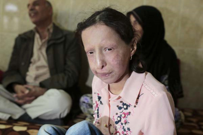 Dnyada nadir grlen Rothmund-Thomson Sendromuna yakalanan, 13 yandaki Suriyeli Zeve brahim, ayn hastala yakalanan erkek kardei gibi lmek istemiyor. Suriye