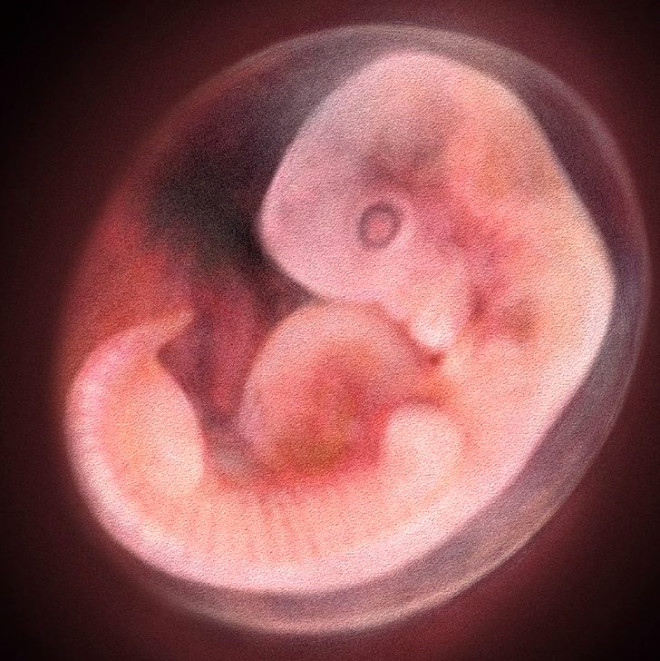 
Bir insan embriyosunun, gelecekte ani lme neden olan ve sk grlen bir kalp hastaln tetikleyen genlere sahip olduu saptanmt.



 

