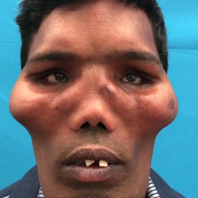 Aslan Surat Sendromuyla 18 yandan beri mcadele eden Hindistanl Suresh, dayanlmaz aclar ekiyordu ve bu hastaln tedavisi olduka zor grnyordu.