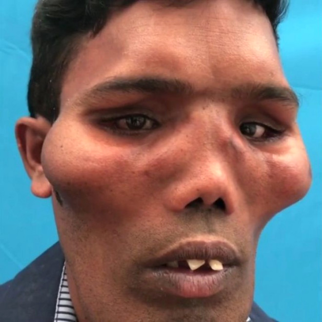 Suresh, 20 yl boyunca bu hastaln penesinde yaamt. Kemiklerin bymesinden kaynaklanan sendromun tedavisi iin kemiklerin alnmas gerekiyordu.