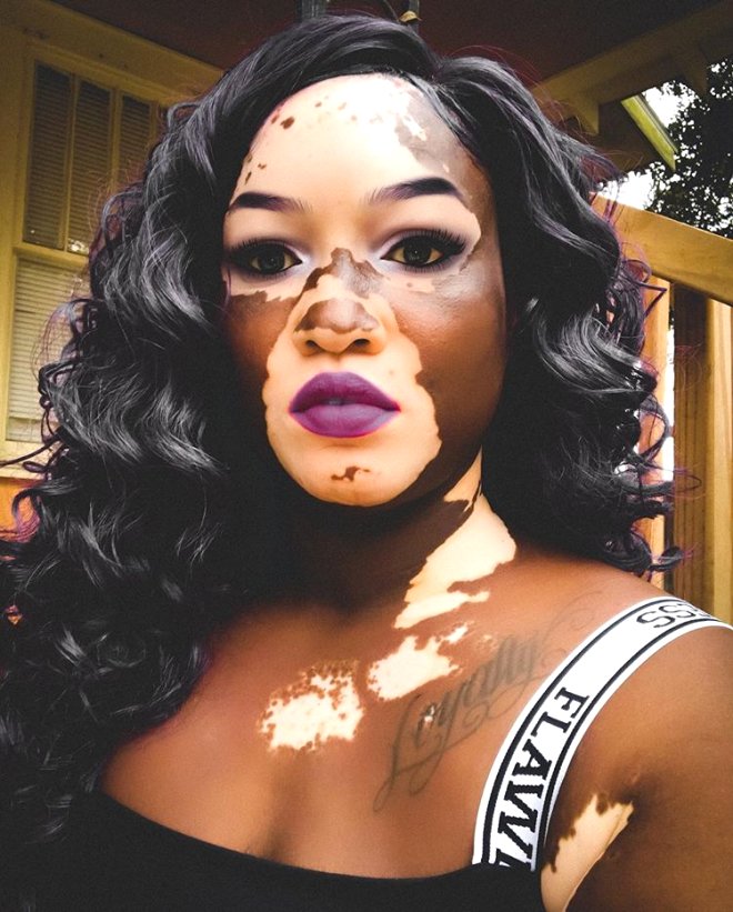 Model, kitabnn vitiligo