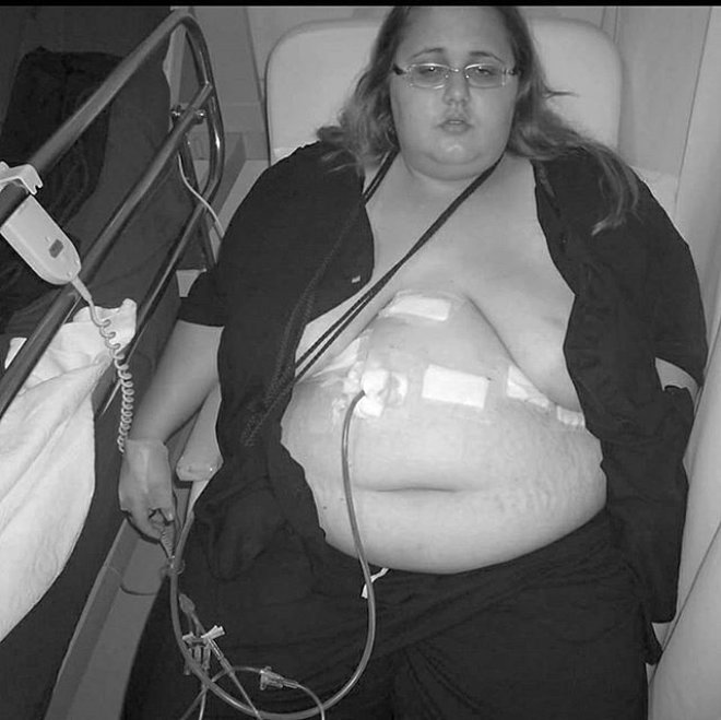 Ancak Jessica iin iler hi de kolay deildi. Kilo vermeyi istemesine karn artk hareket etmekte bile zorlanyordu. Gnnn ounu yatakta televizyon izleyerek ve yemek yiyerek geiriyordu. Sonunda Jessica lmle yaam arasnda bir tercih yapt ve 2010 ylnda obezite ameliyat olmaya karar verdi ve ameliyat ncesi kilo kaybetmek iin hareket etmeye ve dk karbonhidratl bir diyet uygulamaya balad.