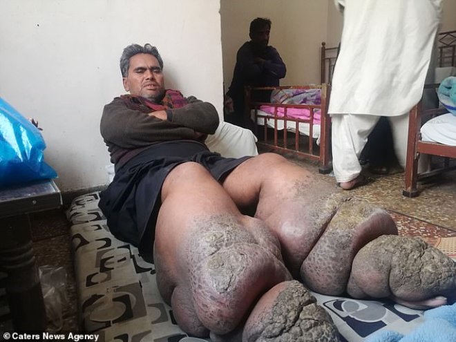 Gen adamn bacaklarnn arl, 110 kiloyu buldu ve bu durum Hussain