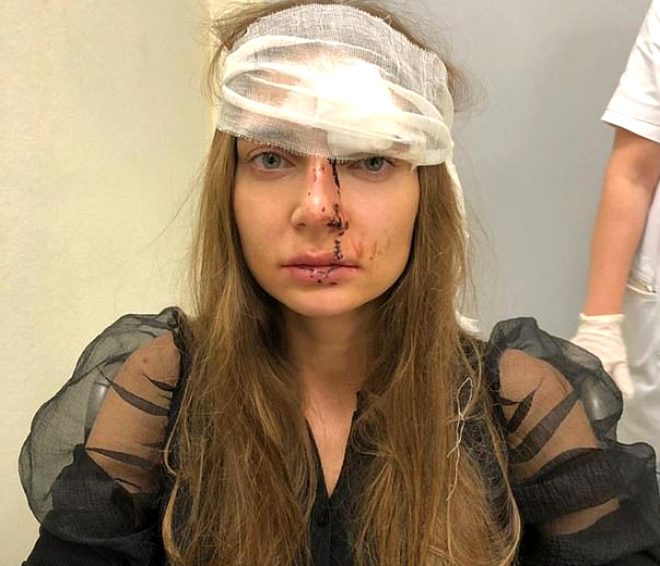 Rus arkc ve oyuncu Valentina Sidorova, dudak estetii iin gittii bir gzellik merkezinde, kadn cerrahn saldrsna uradn iddia ederek, kanlar iindeki grntsn paylat.