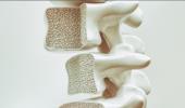 Osteoporoz (Kemik Erimesi) nedir?